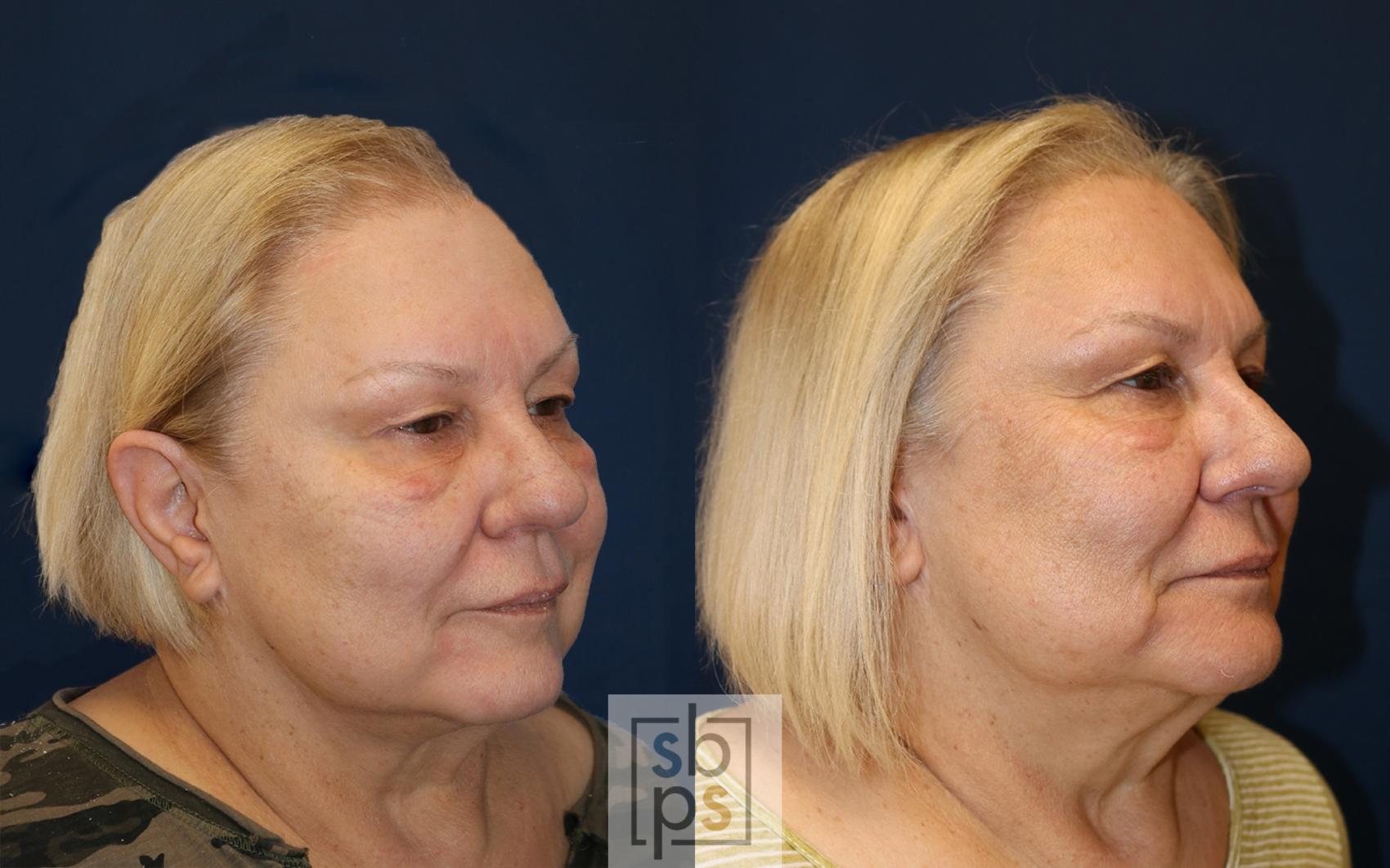 Before & After Chemical Peels Case 489 Right Oblique View in Torrance & Los Angeles, CA, CA