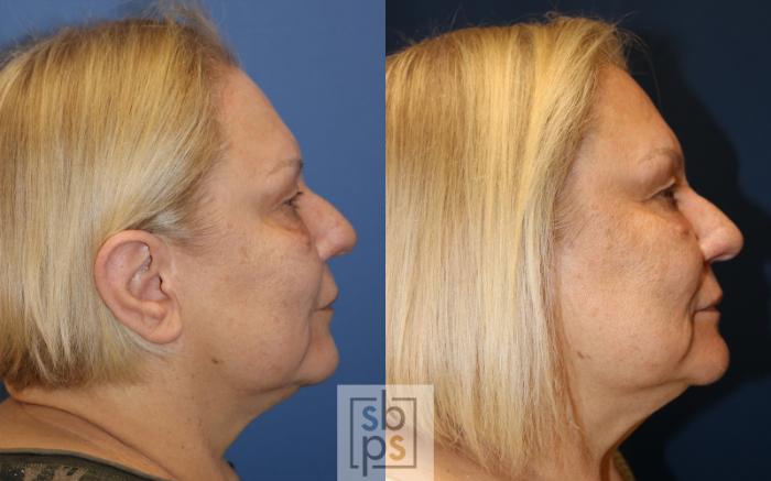 Before & After Chemical Peels Case 489 Right Side View in Torrance, CA