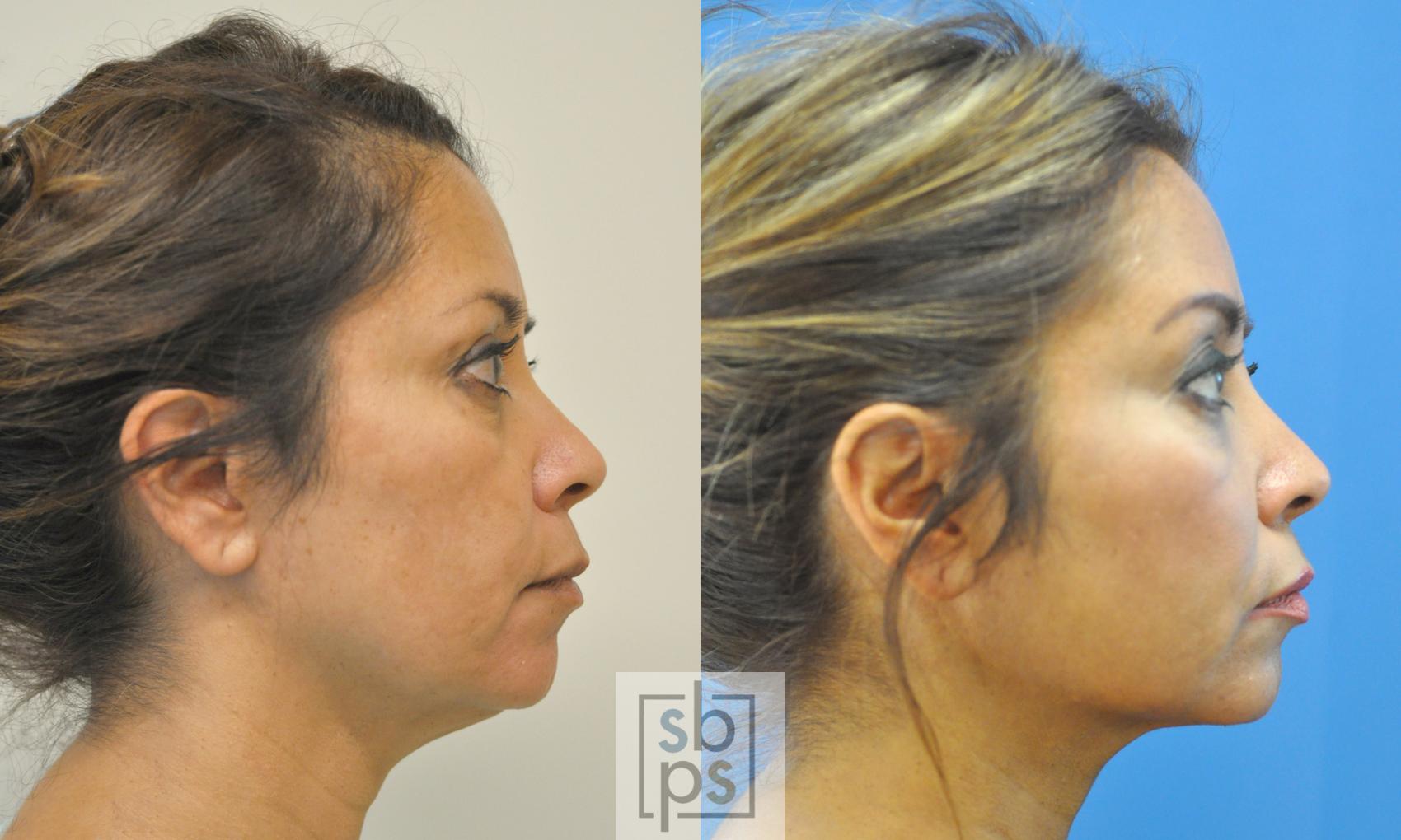 Before & After Chin Liposuction Case 191 View #1 View in Torrance, CA