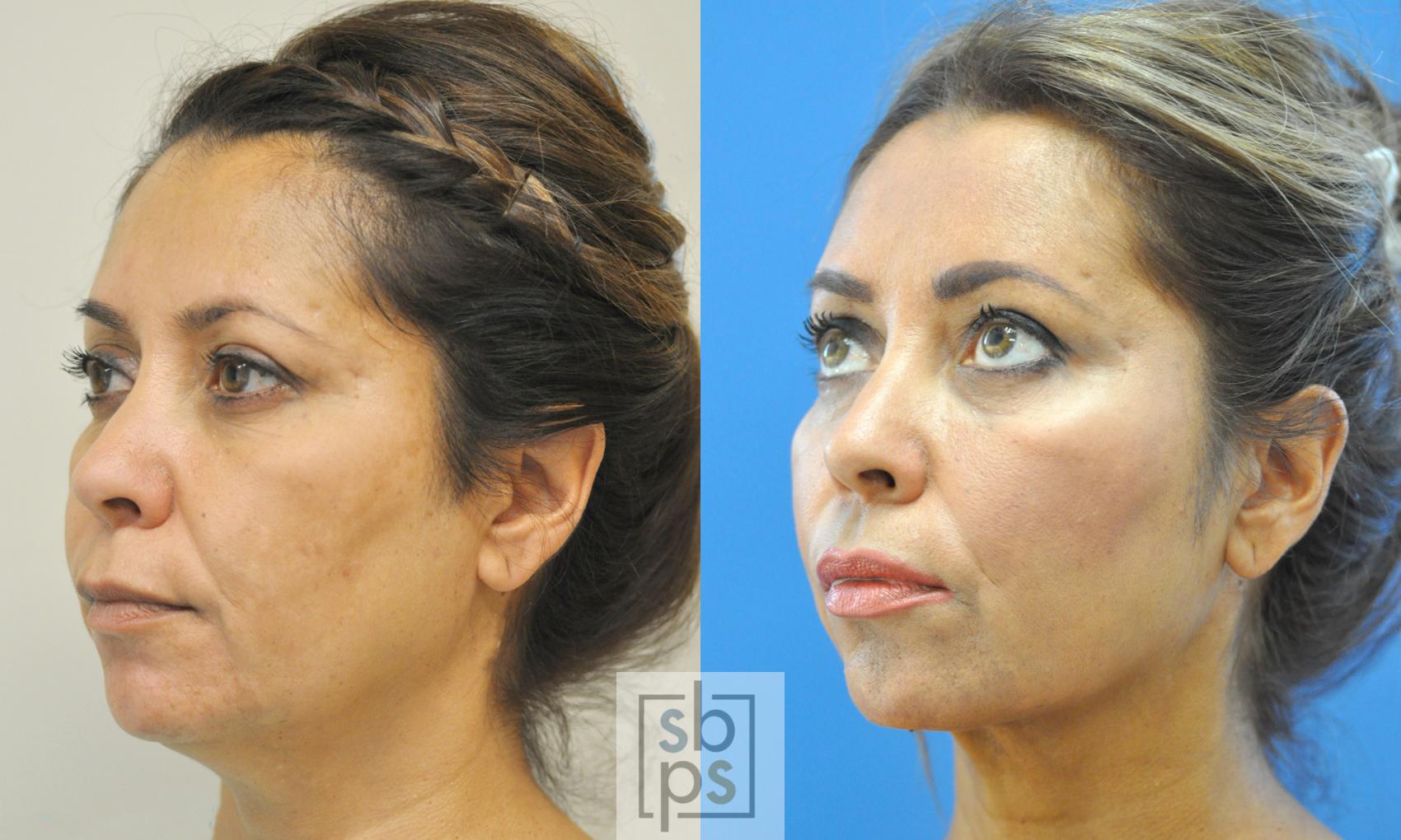 Before & After Chin Liposuction Case 191 View #2 View in Torrance & Los Angeles, CA, CA