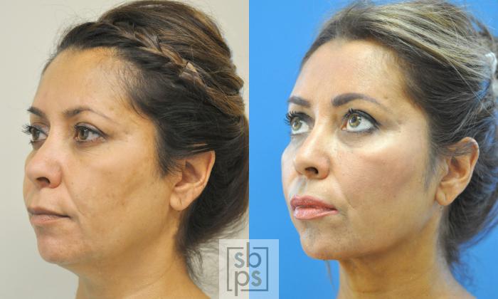 Before & After Chin Liposuction Case 191 View #2 View in Torrance, CA