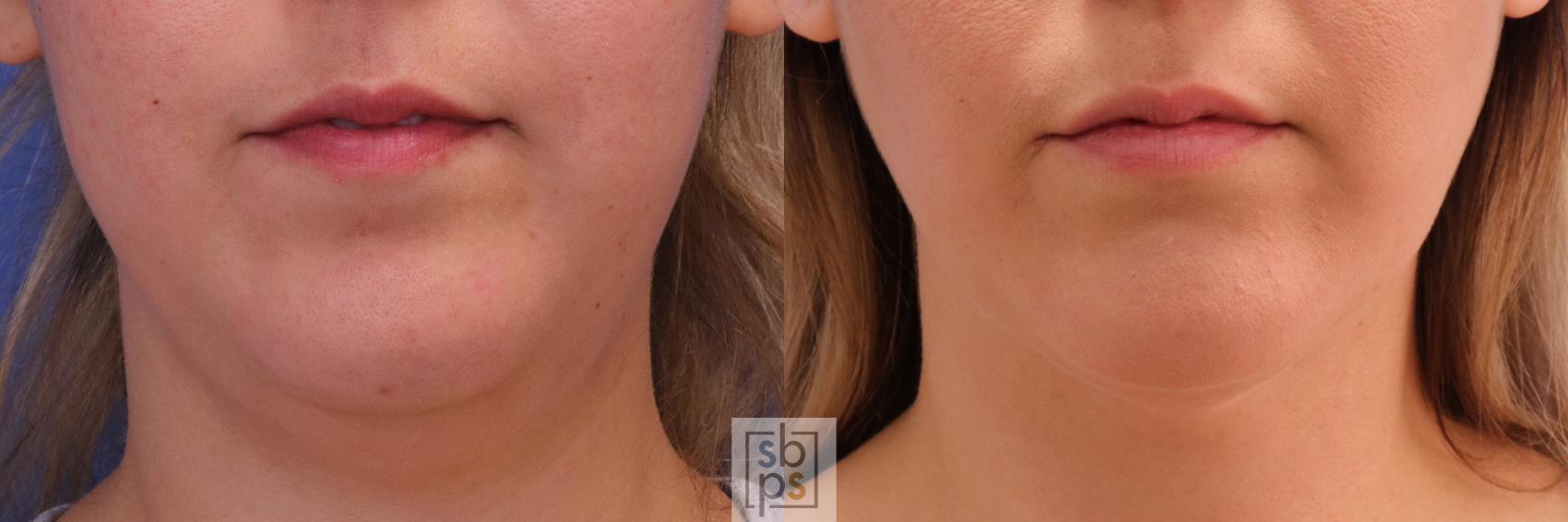 Before & After Chin Liposuction Case 293 View #1 View in Torrance, CA