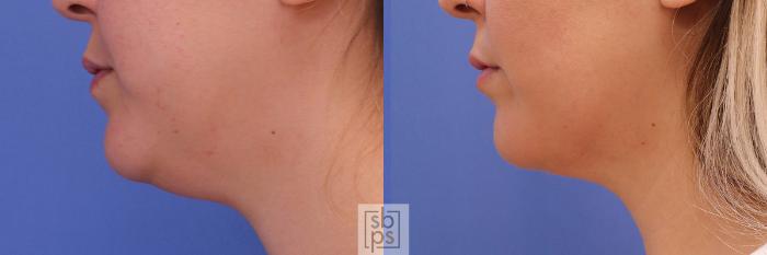 Before & After Chin Liposuction Case 293 View #2 View in Torrance, CA