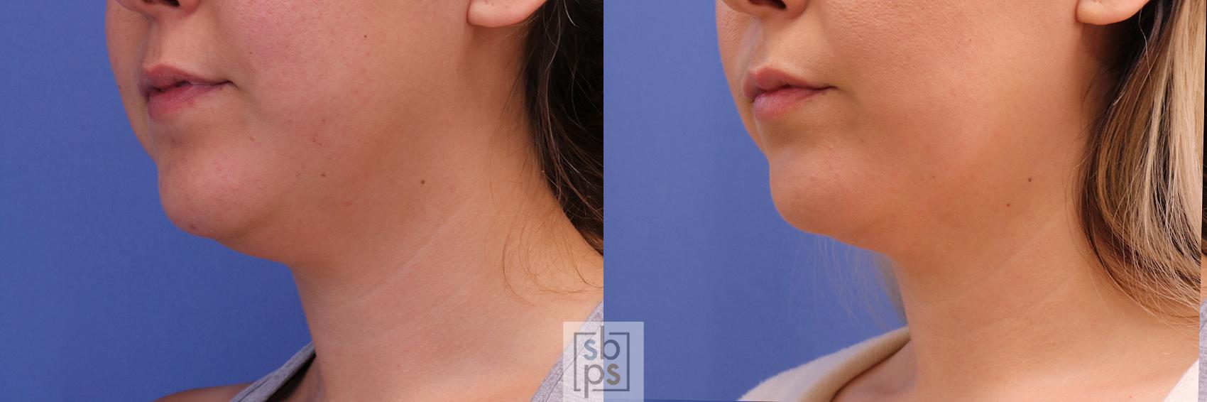 Before & After Chin Liposuction Case 293 View #3 View in Torrance & Los Angeles, CA, CA