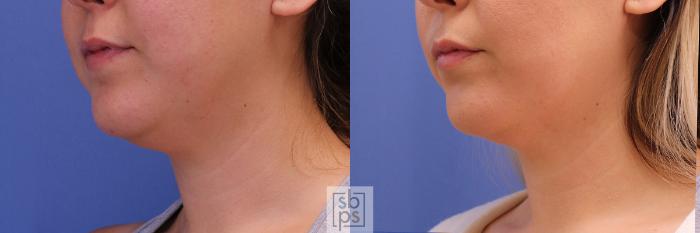 Before & After Chin Liposuction Case 293 View #3 View in Torrance, CA