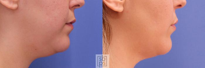 Before & After Chin Liposuction Case 293 View #4 View in Torrance, CA