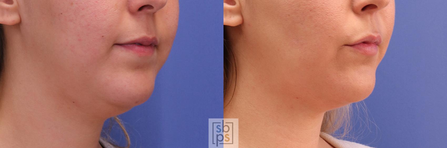 Before & After Chin Liposuction Case 293 View #5 View in Torrance & Los Angeles, CA, CA