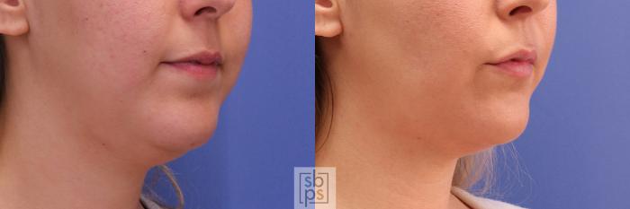 Before & After Chin Liposuction Case 293 View #5 View in Torrance, CA
