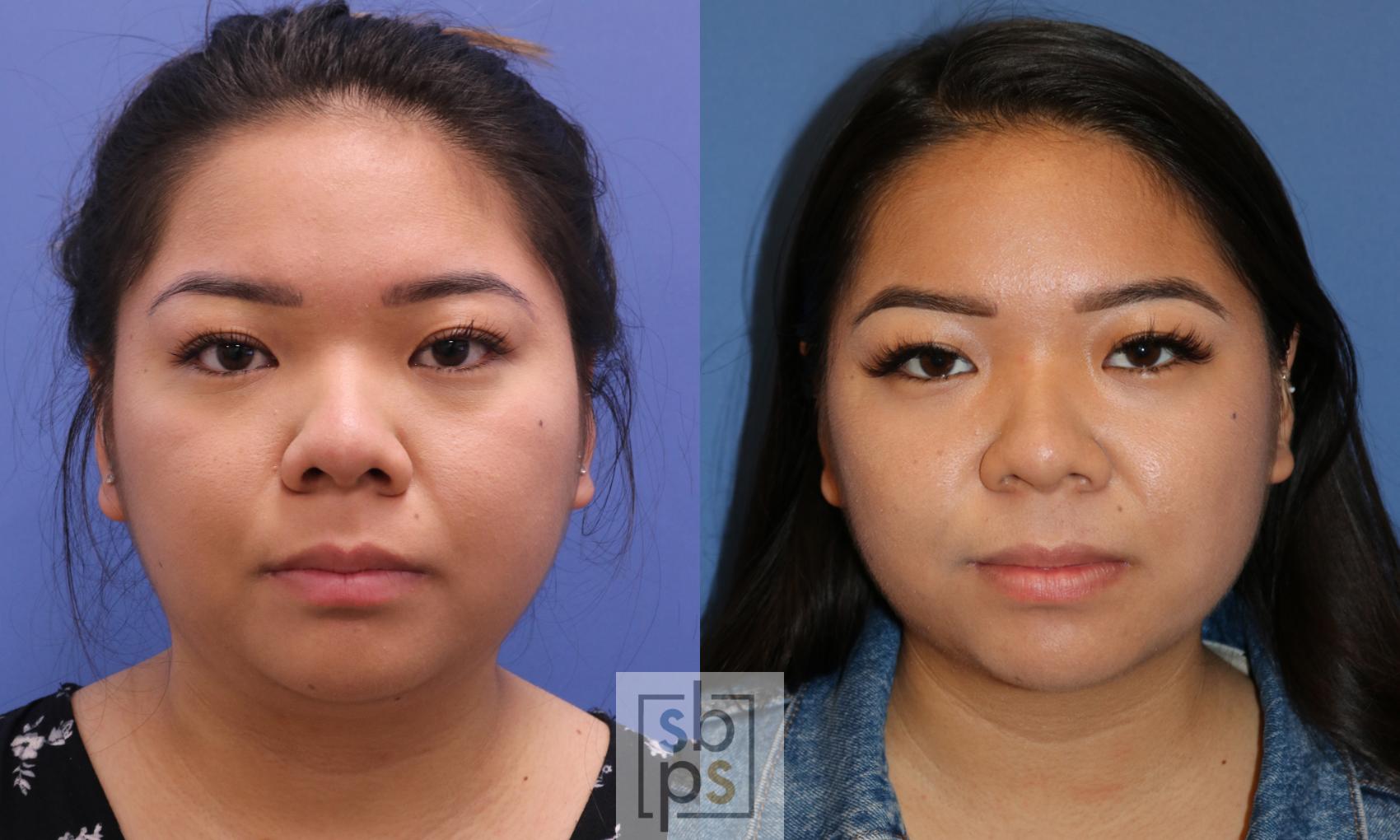 Before & After Chin Liposuction Case 337 View #1 View in Torrance, CA