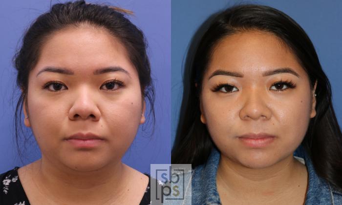 Before & After Chin Liposuction Case 337 View #1 View in Torrance, CA