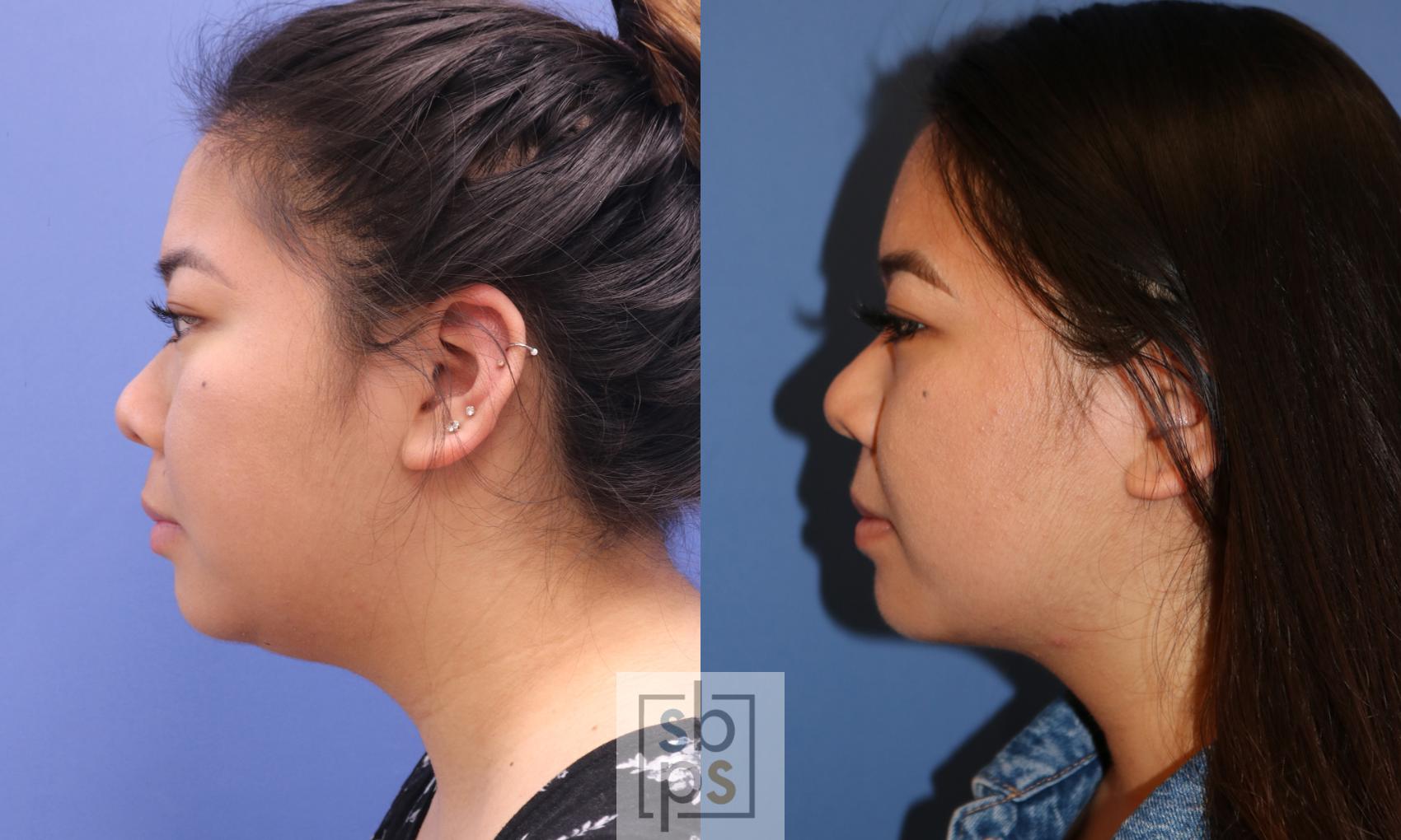 Before & After Chin Liposuction Case 337 View #2 View in Los Angeles, Torrance & Long Beach, CA