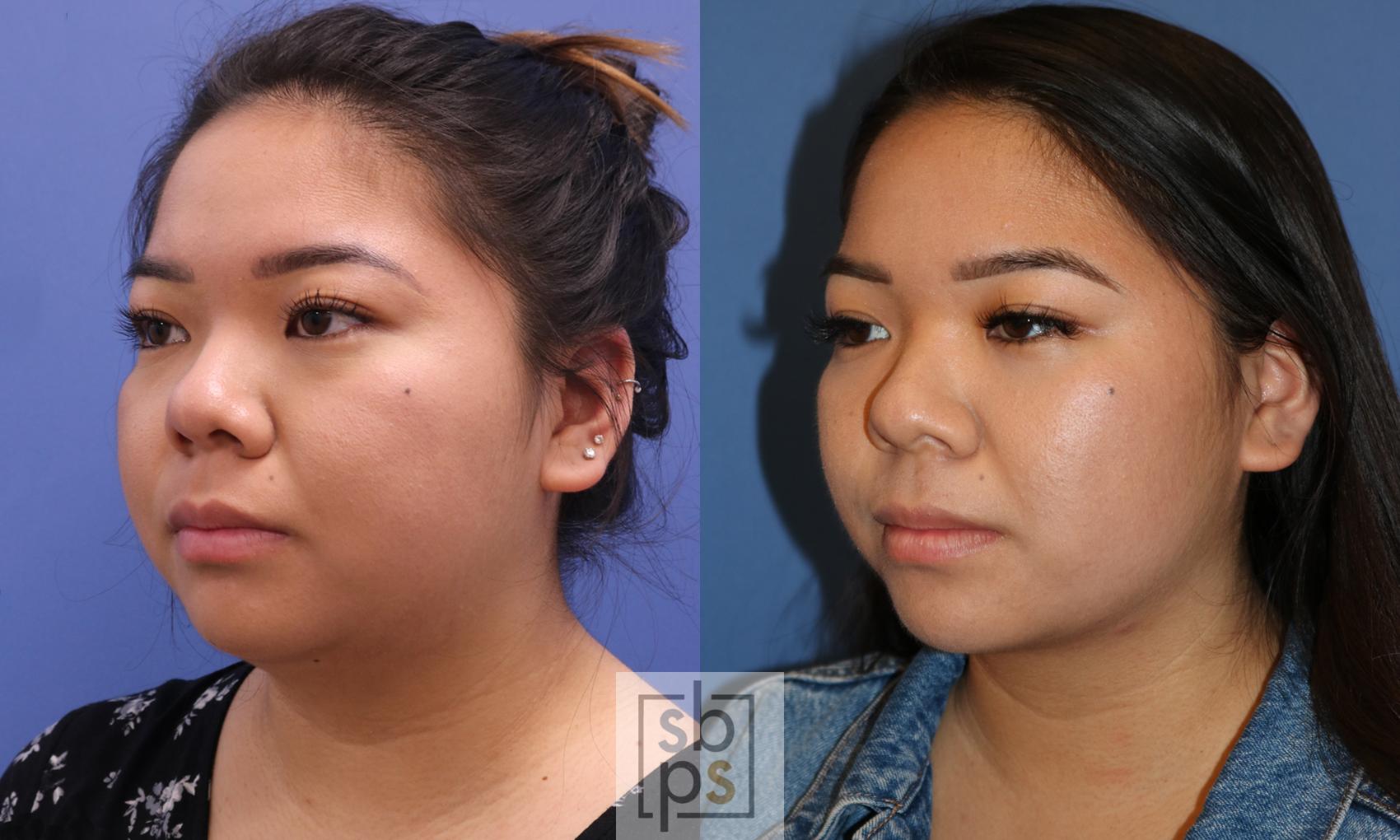 Before & After Chin Liposuction Case 337 View #3 View in Los Angeles, Torrance & Long Beach, CA