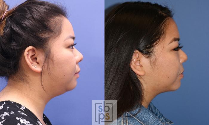 Before & After Chin Liposuction Case 337 View #4 View in Torrance, CA