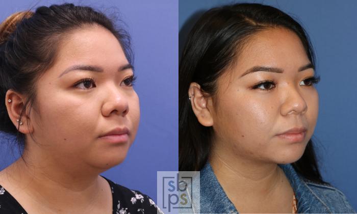 Before & After Chin Liposuction Case 337 View #5 View in Torrance, CA