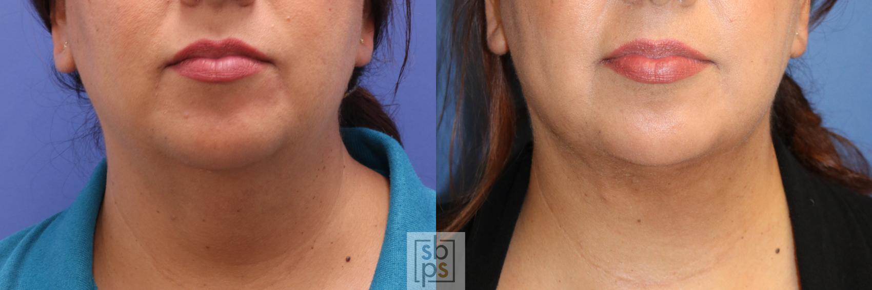 Before & After Chin Liposuction Case 338 View #1 View in Torrance, CA