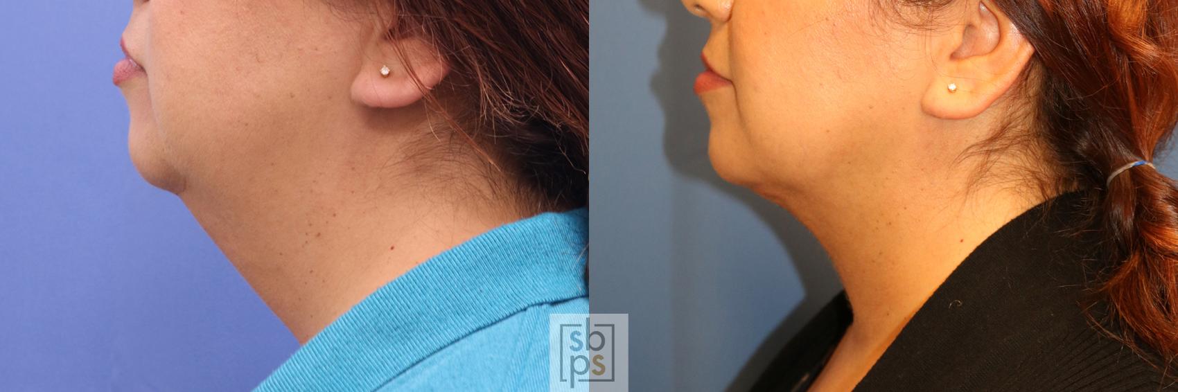 Before & After Chin Liposuction Case 338 View #2 View in Torrance, CA
