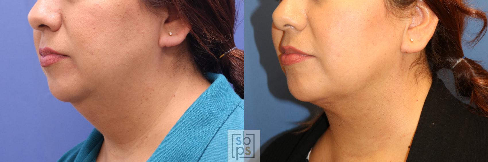 Before & After Chin Liposuction Case 338 View #3 View in Torrance, CA