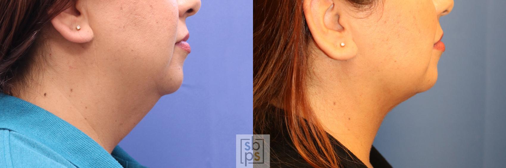 Before & After Chin Liposuction Case 338 View #4 View in Torrance, CA