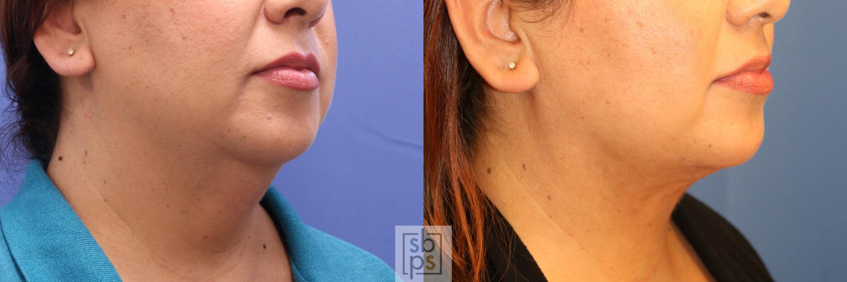 Before & After Chin Liposuction Case 338 View #5 View in Torrance, CA