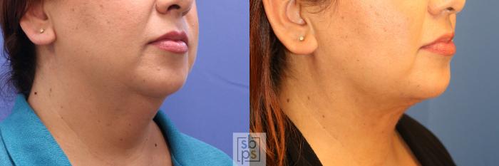 Before & After Chin Liposuction Case 338 View #5 View in Torrance, CA
