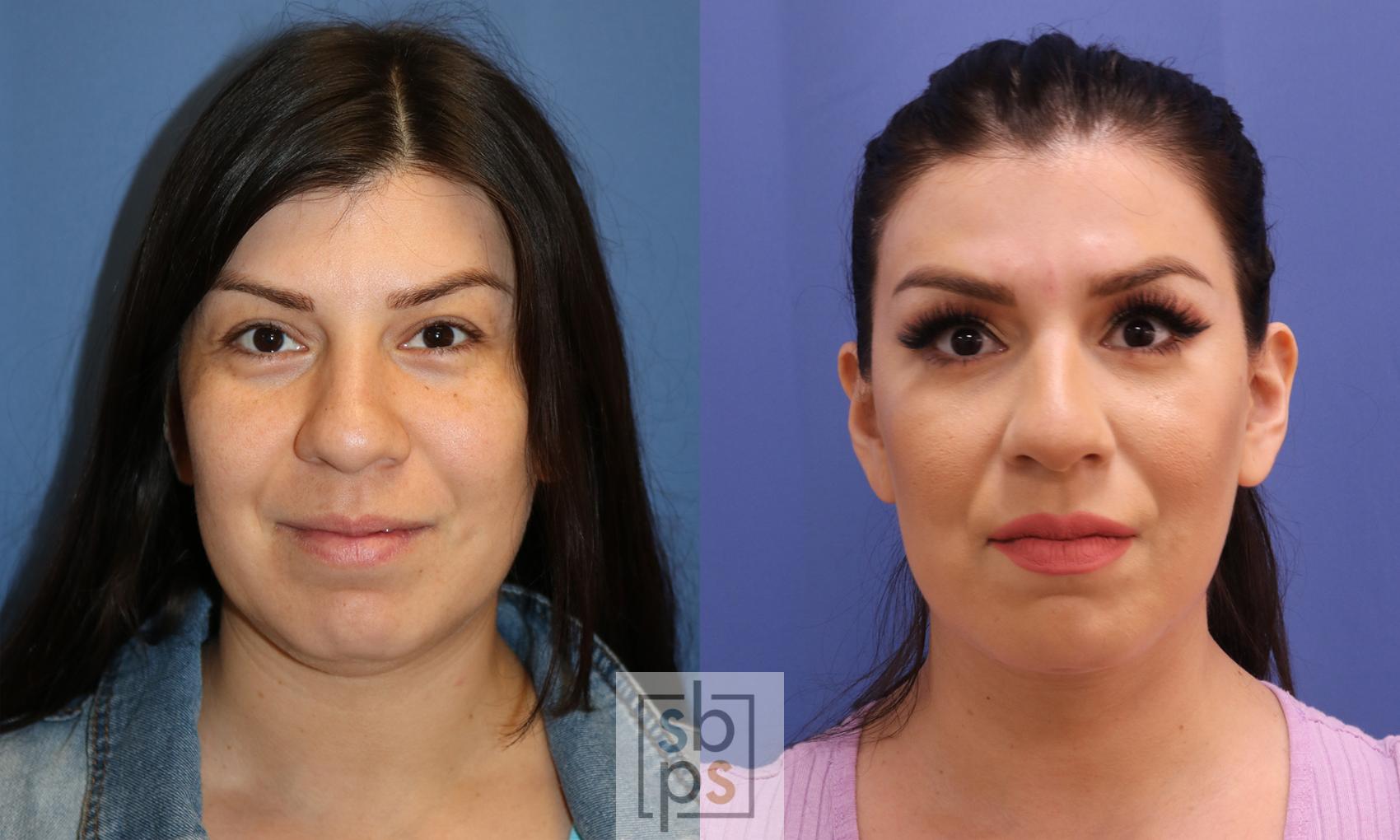 Before & After Chin Liposuction Case 339 View #1 View in Torrance, CA
