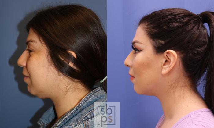 Before & After Chin Liposuction Case 339 View #2 View in Torrance, CA