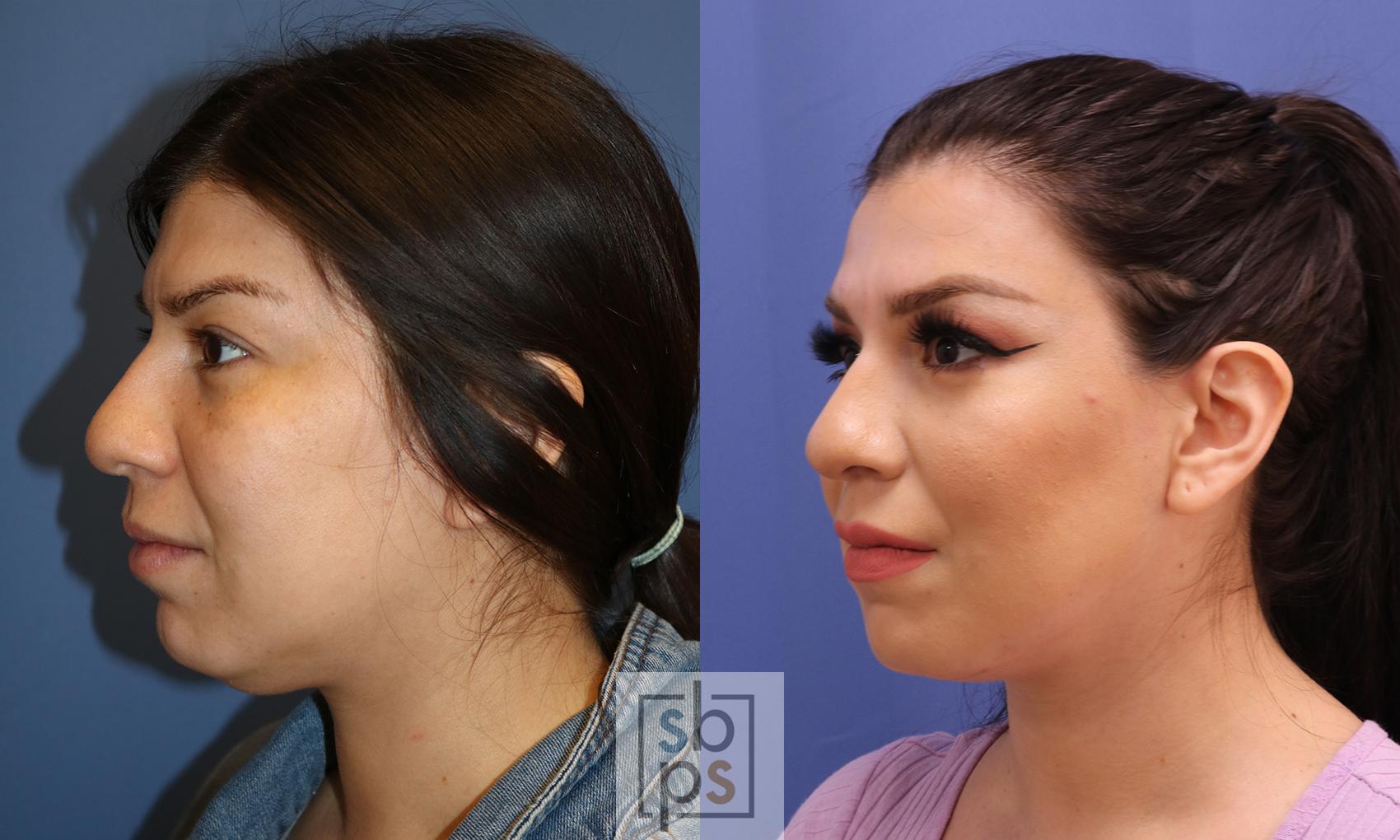 Before & After Chin Liposuction Case 339 View #3 View in Torrance & Los Angeles, CA, CA