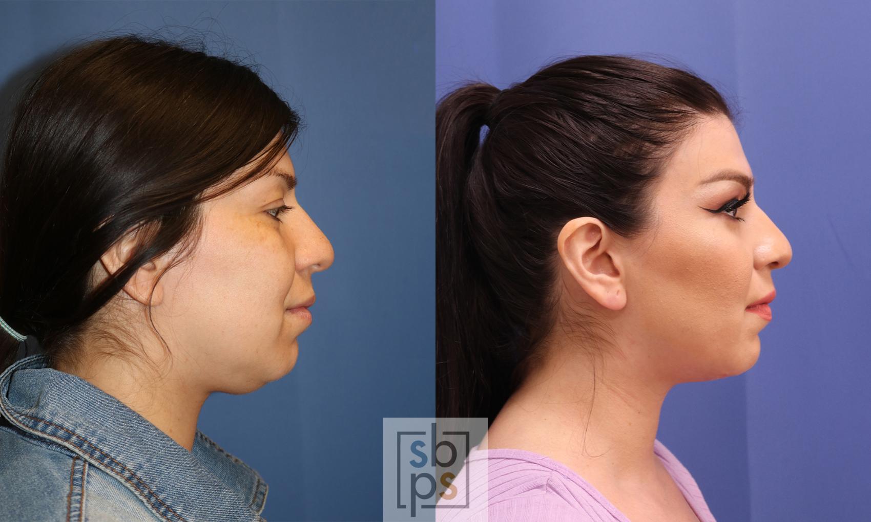 Before & After Chin Liposuction Case 339 View #4 View in Torrance & Los Angeles, CA, CA