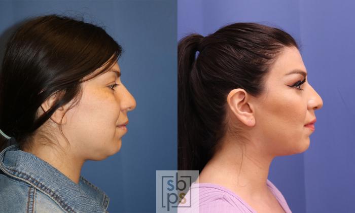 Before & After Chin Liposuction Case 339 View #4 View in Torrance, CA