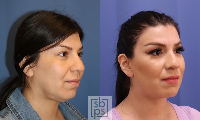 Before & After Chin Liposuction Case 339 View #5 View in Torrance, CA