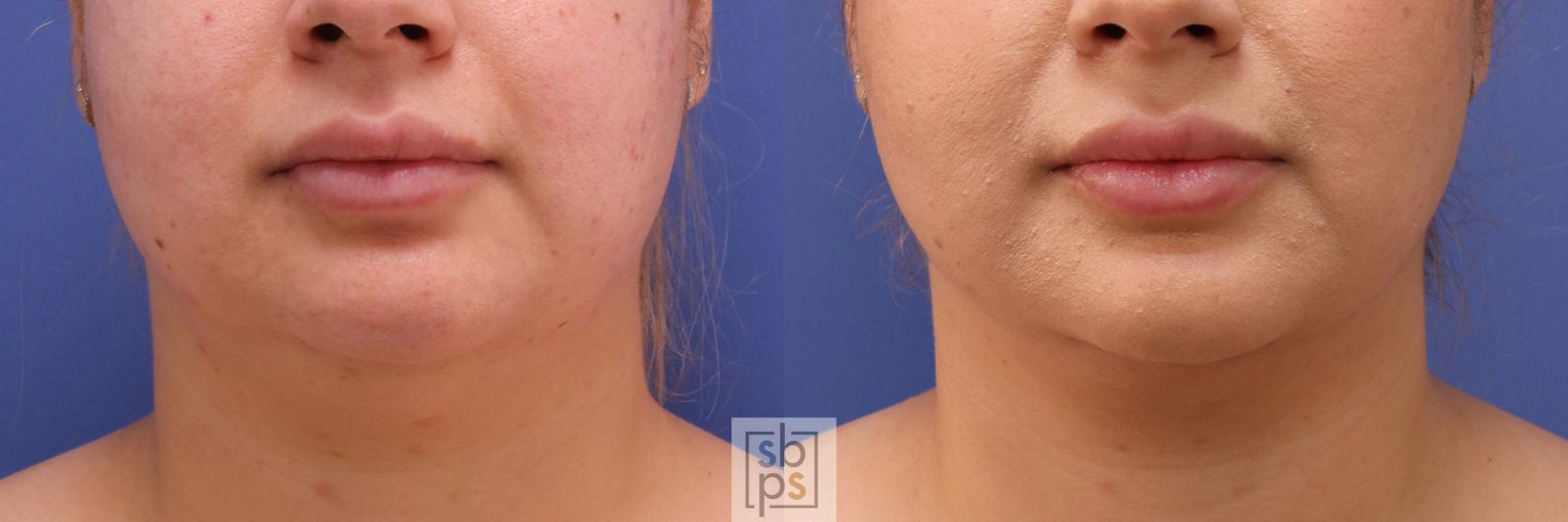 Before & After Chin Liposuction Case 389 Front View in Torrance, CA