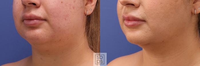 Before & After Chin Liposuction Case 389 Left Oblique View in Torrance, CA