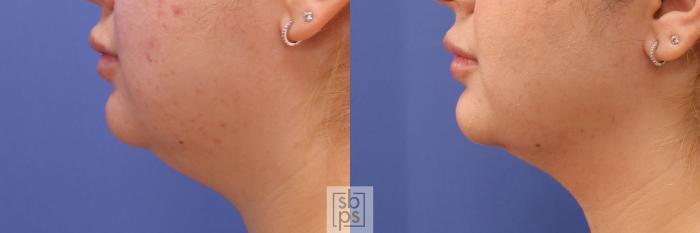 Before & After Chin Liposuction Case 389 Left Side View in Torrance, CA