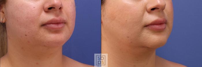 Before & After Chin Liposuction Case 389 Right Oblique View in Torrance, CA