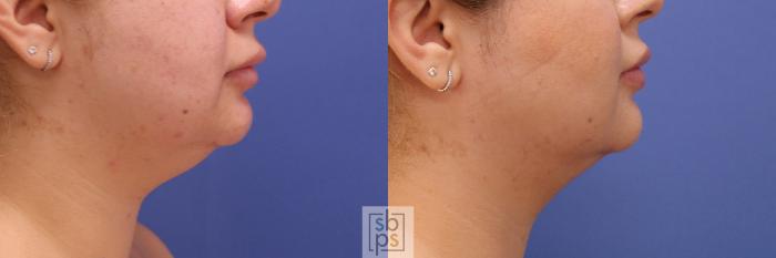Before & After Chin Liposuction Case 389 Right Side View in Torrance, CA