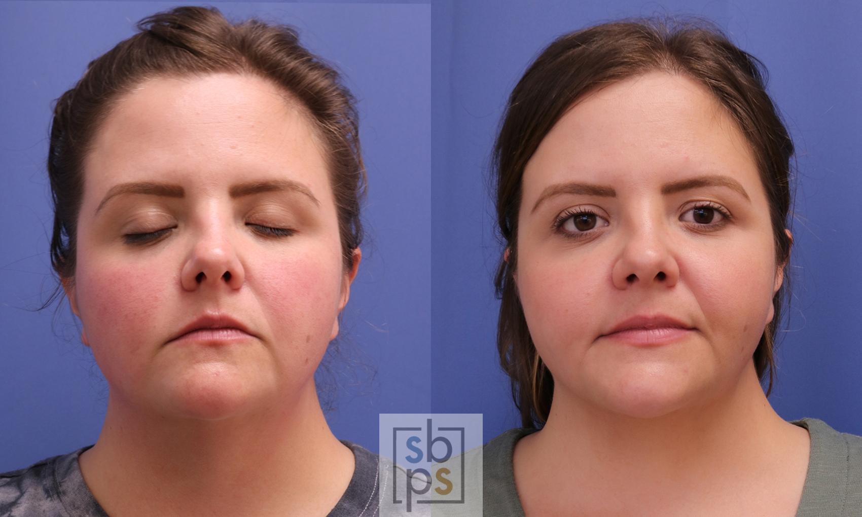 Before & After Chin Liposuction Case 405 Front View in Torrance, CA