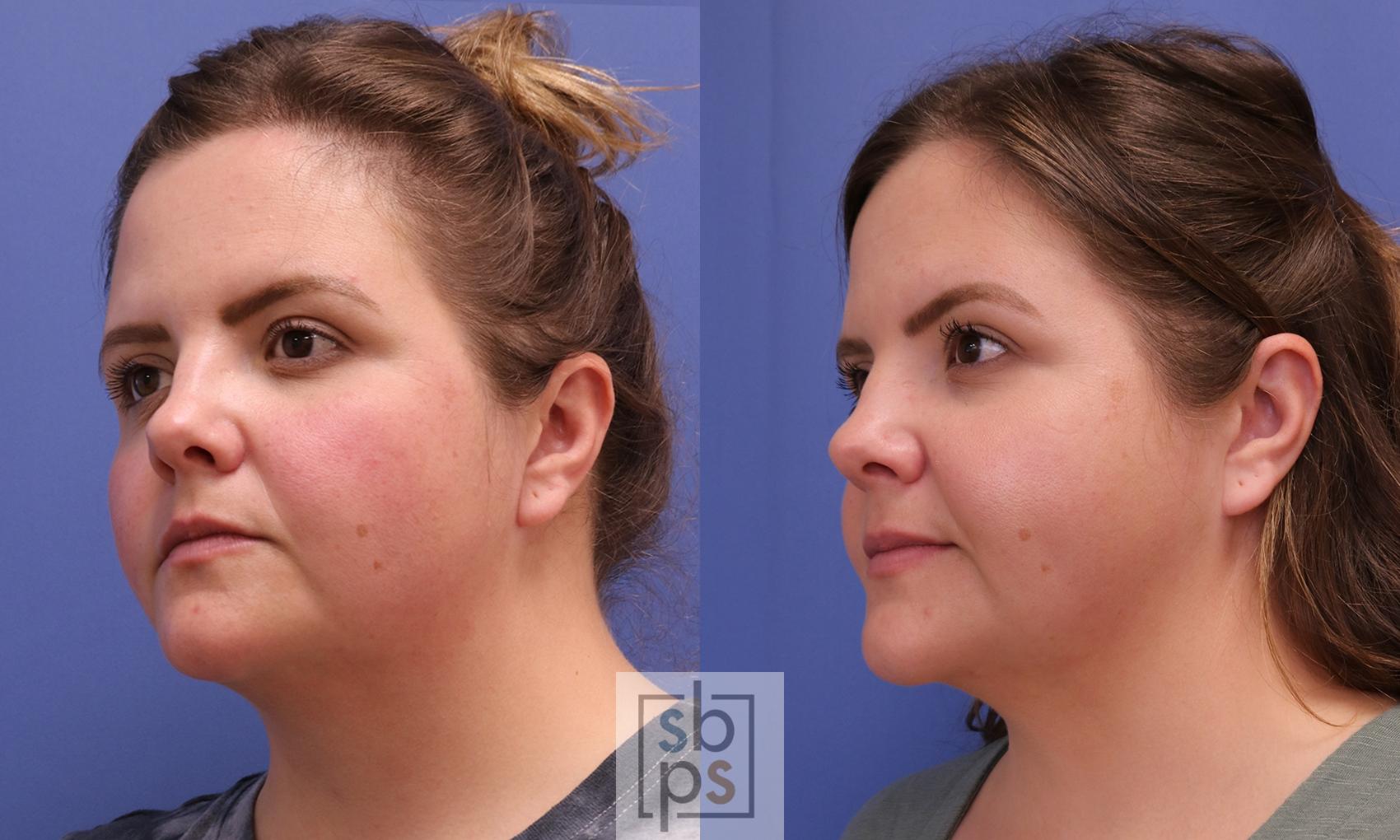 Before & After Chin Liposuction Case 405 Left Oblique View in Torrance & Los Angeles, CA, CA