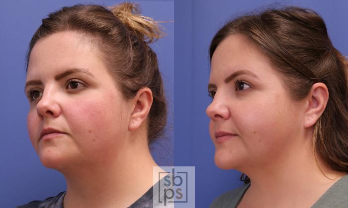 Before & After Chin Liposuction Case 405 Left Oblique View in Torrance, CA