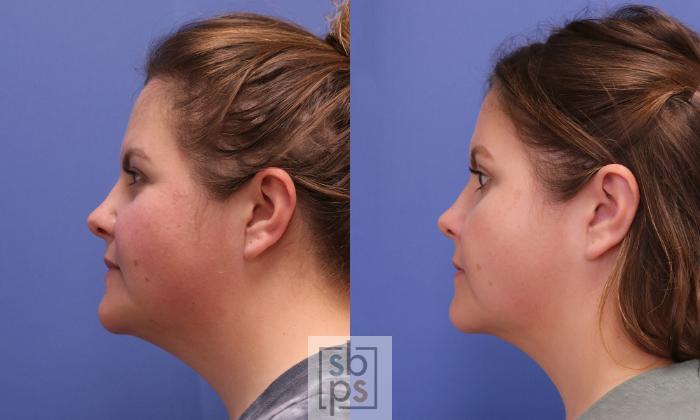 Before & After Chin Liposuction Case 405 Left Side View in Torrance, CA