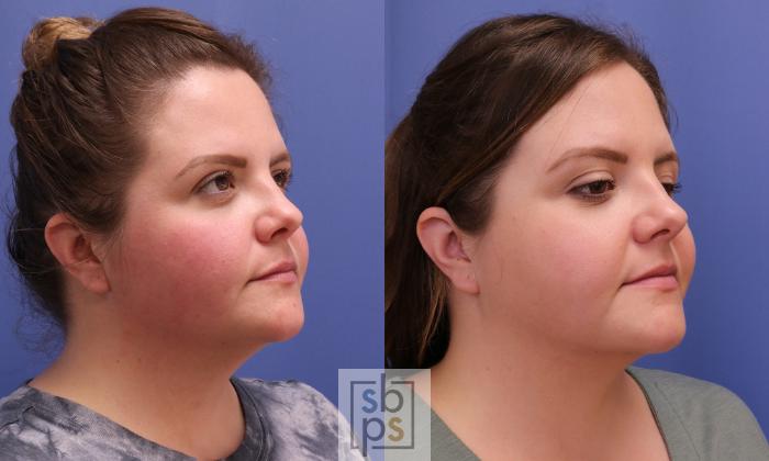 Before & After Chin Liposuction Case 405 Right Oblique View in Torrance, CA
