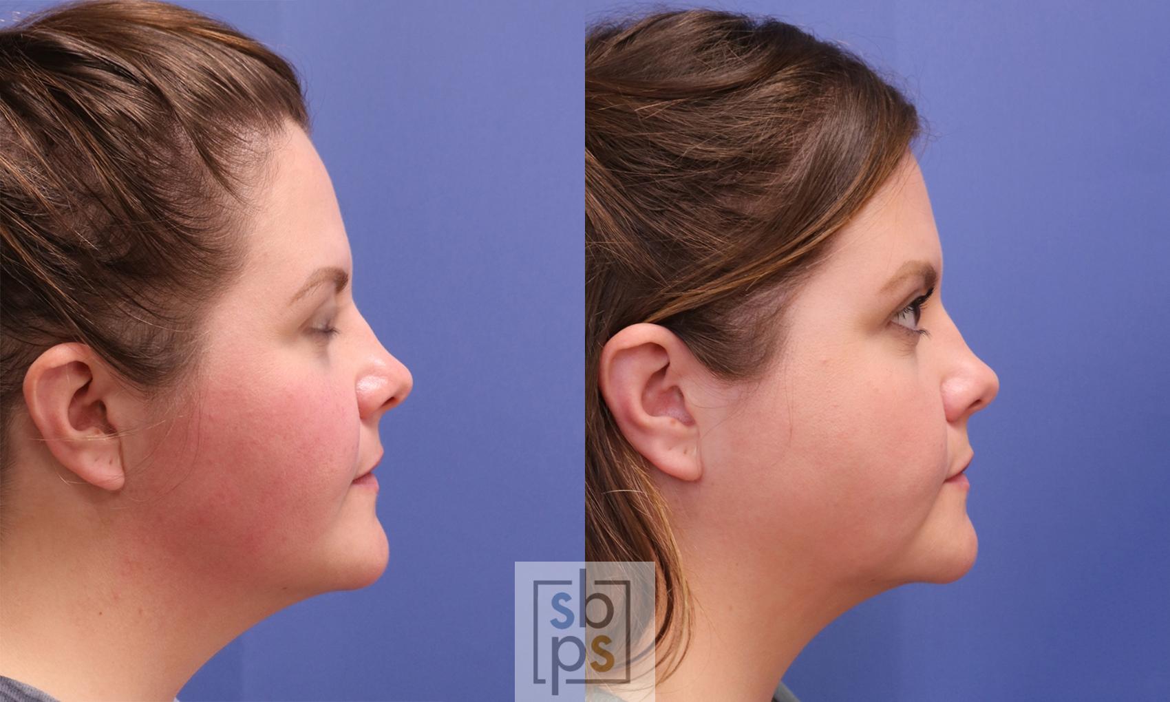 Before & After Chin Liposuction Case 405 Right Side View in Torrance & Los Angeles, CA, CA