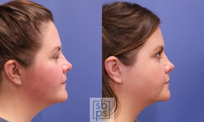 Before & After Chin Liposuction Case 405 Right Side View in Torrance, CA