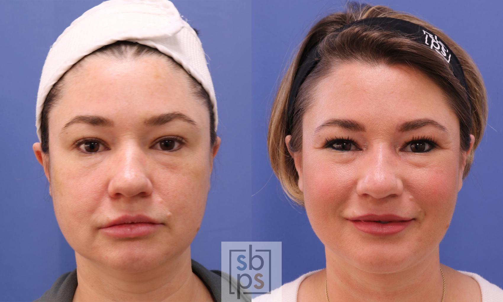 Before & After Chin Liposuction Case 455 Front View in Torrance, CA