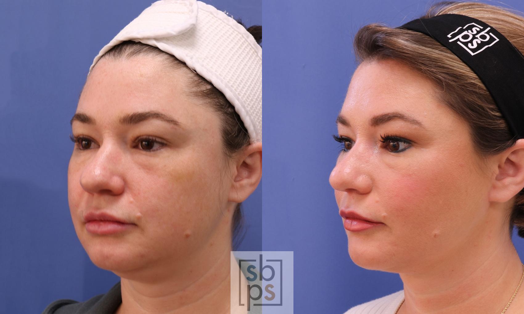 Before & After Chin Liposuction Case 455 Left Oblique View in Torrance & Los Angeles, CA, CA