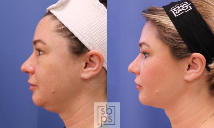 Before & After Chin Liposuction Case 455 Left Side View in Torrance, CA