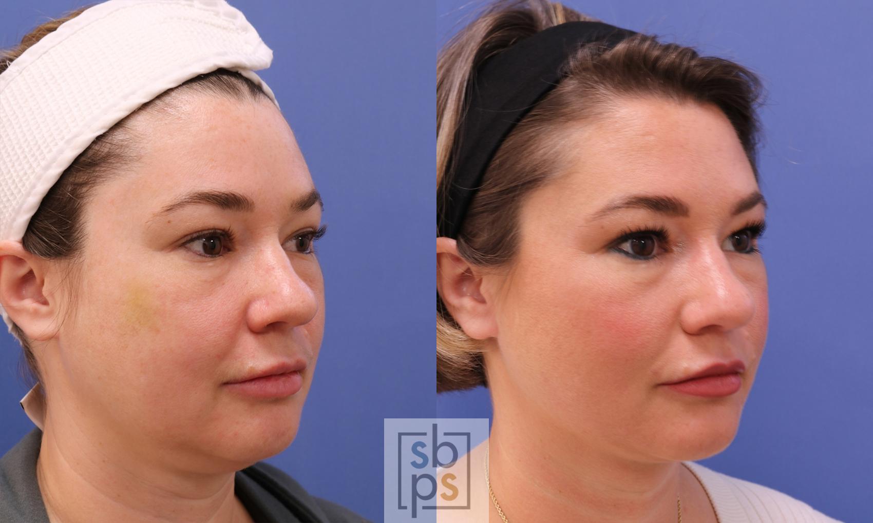 Before & After Chin Liposuction Case 455 Right Oblique View in Torrance & Los Angeles, CA, CA