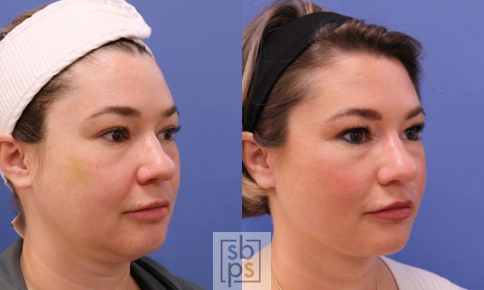 Before & After Chin Liposuction Case 455 Right Oblique View in Torrance, CA