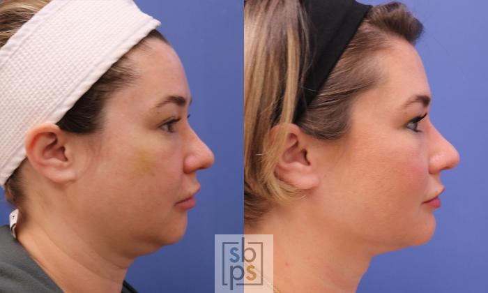 Before & After Chin Liposuction Case 455 Right Side View in Torrance, CA