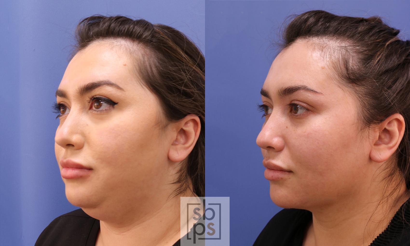 Before & After Chin Liposuction Case 472 Left Oblique View in Torrance & Los Angeles, CA, CA
