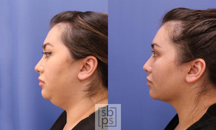 Before & After Chin Liposuction Case 472 Left Side View in Torrance, CA